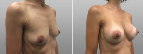 Breast Augmentation Photos 21 Boob job surgery before and after, image 100, angle view