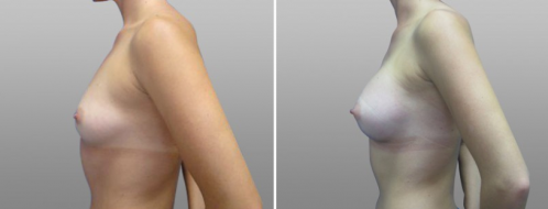 Breast Augmentation Photos 82 Breast augmentation before and after, Form & Face clinic Sydney, patient 20, side view