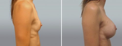 Breast Augmentation Photos 62 Breast augmentation with implants, side view, patient 33, image 59, side view