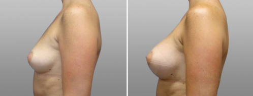 Breast Augmentation Photos 10 Boob job gallery, image 09, side view