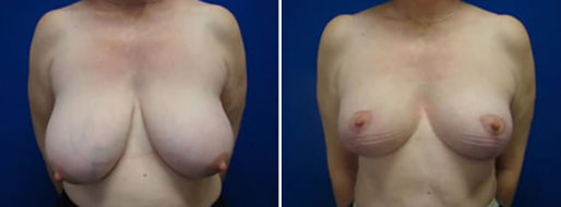Breast Reduction Photos 28 Patient before and after breast reduction at Form & Face Sydney, image 28