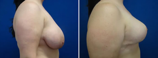 Breast Reduction Photos 35 Breast reduction gallery, patient 12, image 35, side view