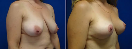 Breast Reduction Photos 40 Breast reduction, patient 15, angle view, image 40