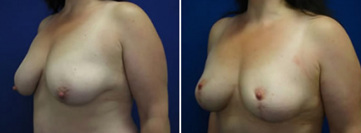 Breast Reduction Photos 51 Breast reduction before and after, patient 20, angle view, image 51