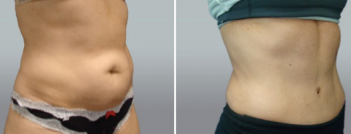 Tummy Tuck Photos 8 Tummy tuck gallery, patient 44, angle view, before and after image