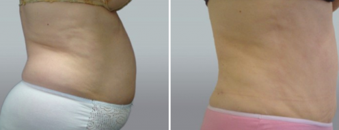 Tummy Tuck Photos 4 Patient 45 before and after abdominoplasty, image 105, side view