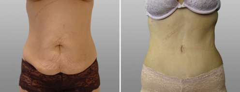 Tummy Tuck Photos 97 Front view of a tummy tuck patient before and after tummy tuck, image 12