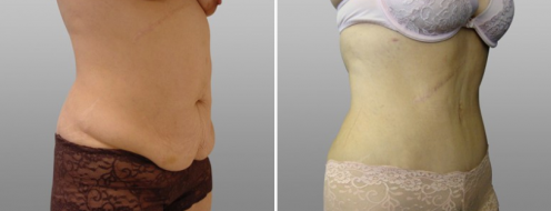 Tummy Tuck Photos 96 Abdominoplasty before & after, patient 5, side view