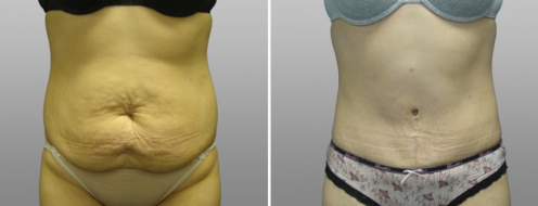 Tummy Tuck Photos 94 Tummy tuck gallery, patient 6, before & after surgery, front view
