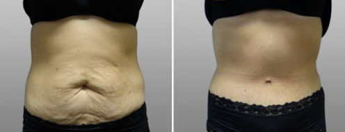 Tummy Tuck Photos 91 Patient 7, front, tummy tuck before and after