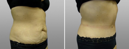 Tummy Tuck Photos 90 Abdominoplasty, patient 7, Dr Norris, image gallery