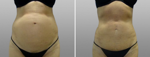 Tummy Tuck Photos 88 Abdominoplasty before and after, image 21, front view