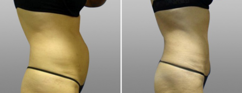 Tummy Tuck Photos 86 Side view of a tummy tuck patient before and after tummy tuck, image 23