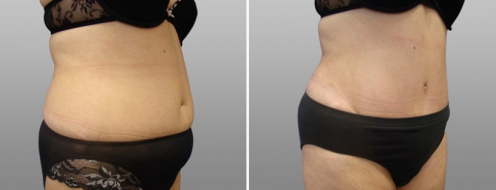 Tummy Tuck Photos 84 Tummy tuck image 25, angle view, Form & Face Sydney