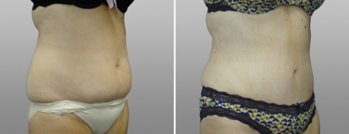 Tummy Tuck Photos 78 Abdominoplasty, patient 11, before & afters gallery