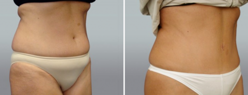 Tummy Tuck Photos 59 Patient 19, tummy tuck before and after image, angle view
