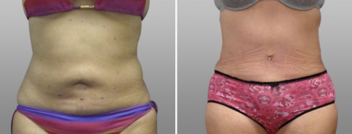 Tummy Tuck Photos 55 Tummy tuck results, patient 21, Dr Norris