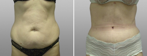 Tummy Tuck Photos 48 Tummy tuck results with Dr Norris, image 61, front view