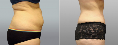 Tummy Tuck Photos 37 Patient 28 before and after tummy tuck surgery, side view