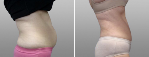 Tummy Tuck Photos 36 Tummy tuck before and after, patient 18, side view