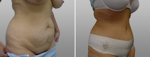 Tummy Tuck Photos 29 Abdominoplasty with Dr Norris, before & after surgery, patient 35