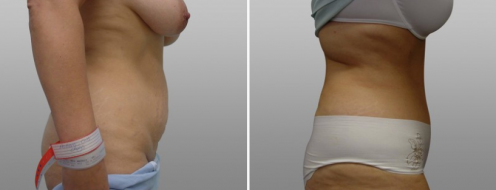 Tummy Tuck Photos 28 Before and after tummy tuck, patient 35, side view