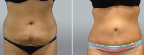 Tummy Tuck Photos 21 Tummy tuck before & afters, image gallery, patient 38, front view