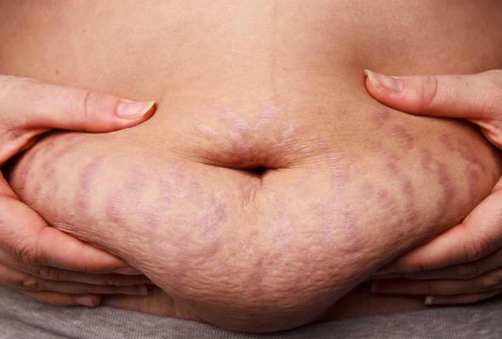 mummies the reimbursement clock is ticking on your tuck lift | Form & Face