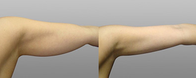 Brachioplasty 5 Arm lift gallery, before and after image 03