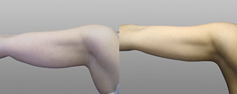 Brachioplasty 6 Patient before and after arm lift, gallery image 04