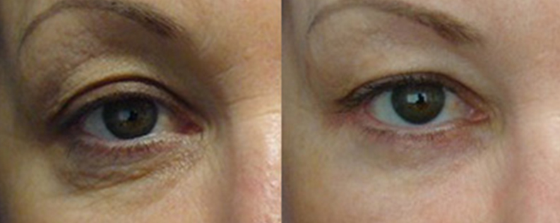 Blepharoplasty 3 Blepharoplasty gallery, a female patient before and after procedure 03
