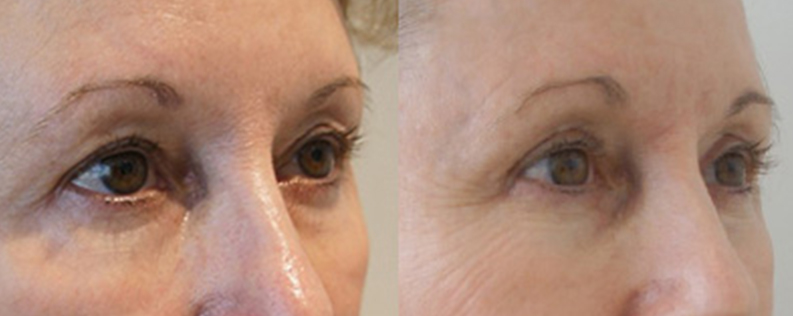Blepharoplasty 4 Blepharoplasty (eyelid surgery) 04, Dr Norris - Form & Face