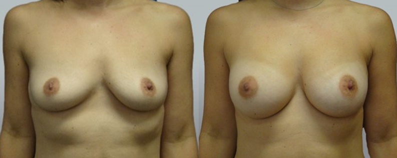Post-Pregnancy Makeover 14 Breast enl 4 | Form & Face