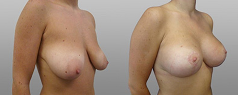 Breast Lift with Implants 3 Patient 01, breast lift and implants before and after, angle view