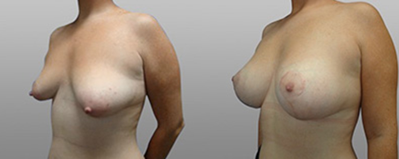 Breast Lift with Implants 4 Breast lift and implants gallery, before and after02, angle view