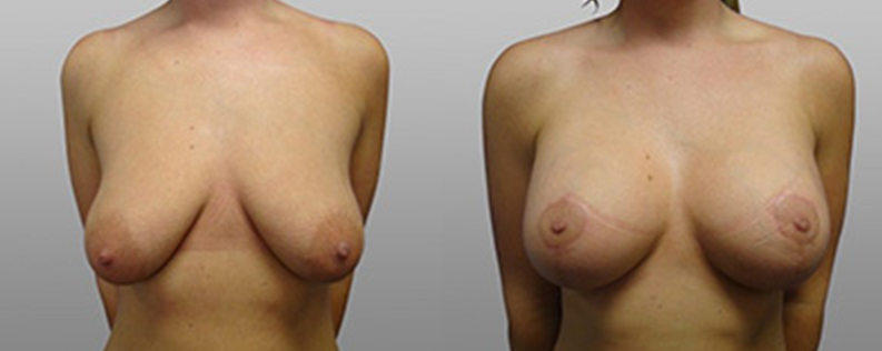 Breast Lift with Implants 5 Breast lift and implants before and after, patient 03