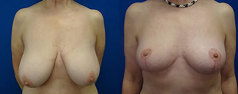 Breast reduction, photo R04, before & after