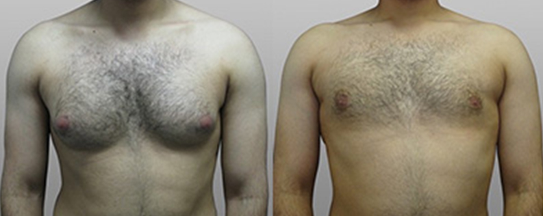 Male breast reduction surgery, patient 01