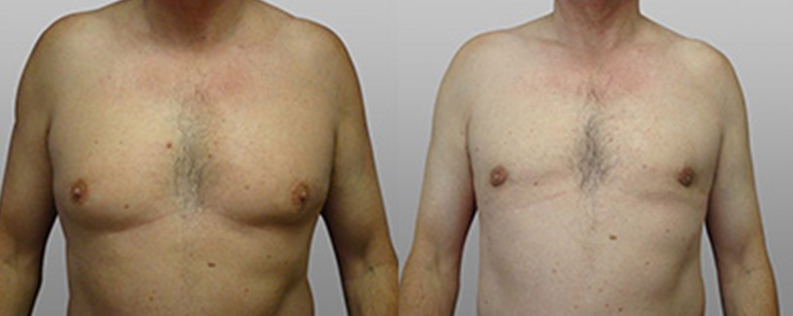 Surgery for gynaecomastia, patient 02, front