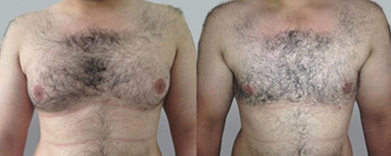 Male breast reduction surgery before and after, patient 03