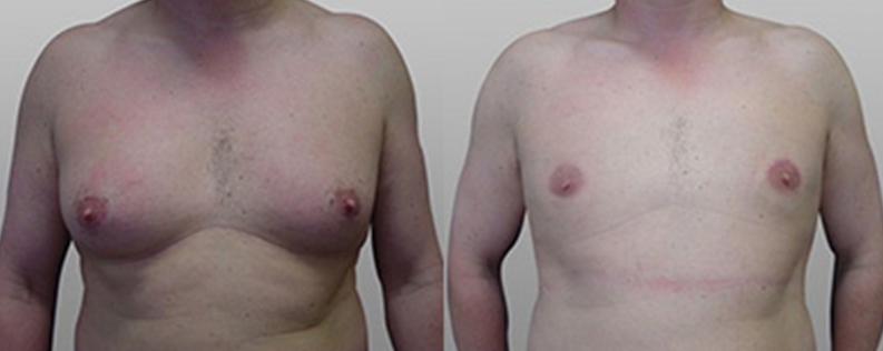 Male breast reduction patient 04, before & after gallery