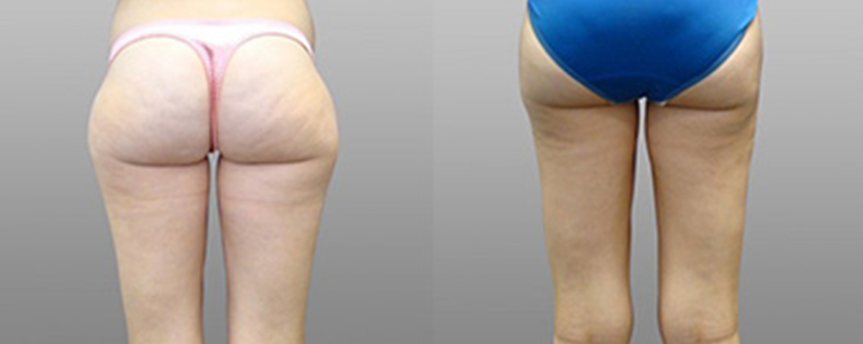 Liposculpture 3 Liposuction before and after 01, back view