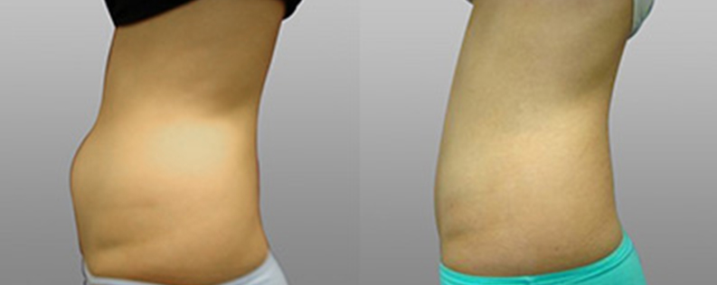 Liposculpture 5 Liposuction photo gallery 03, side view