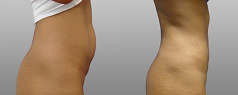 Liposculpture 6 Liposculpture patient photo 04, side view