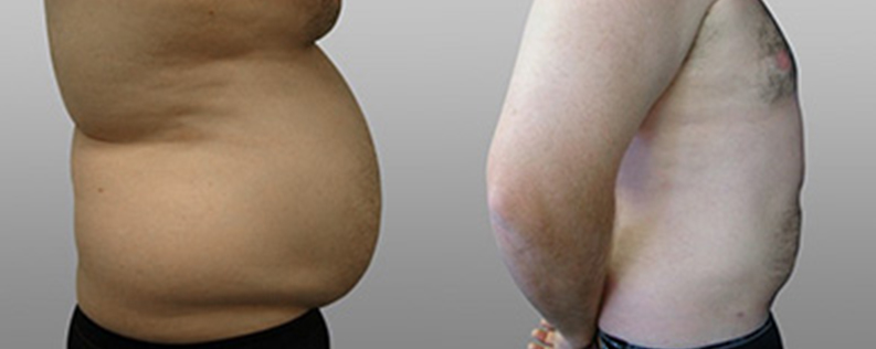 Male Liposuction 5 Male liposculpture, before & afters 03, side view