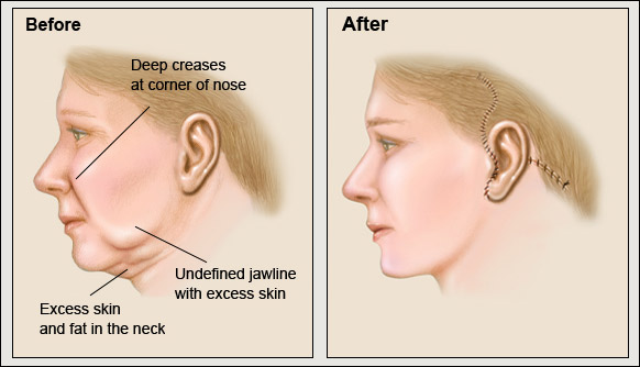 Face and Neck Lift Surgery 3 Before and after facelift surgery illustration