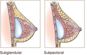 Breast Lift with Implants 9 image0021