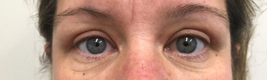 Blepharoplasty (Eyelid) Before & After Gallery 22 Patient2After | Form & Face