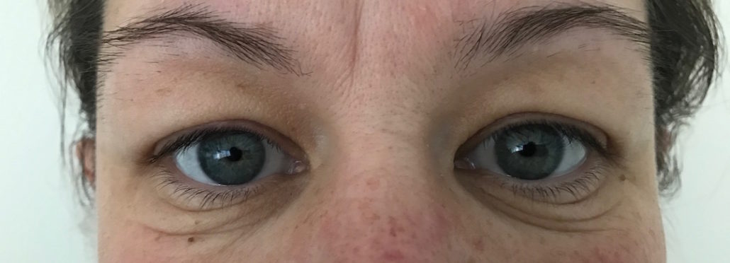 Blepharoplasty (Eyelid) Before & After Gallery 21 Patient2Before | Form & Face