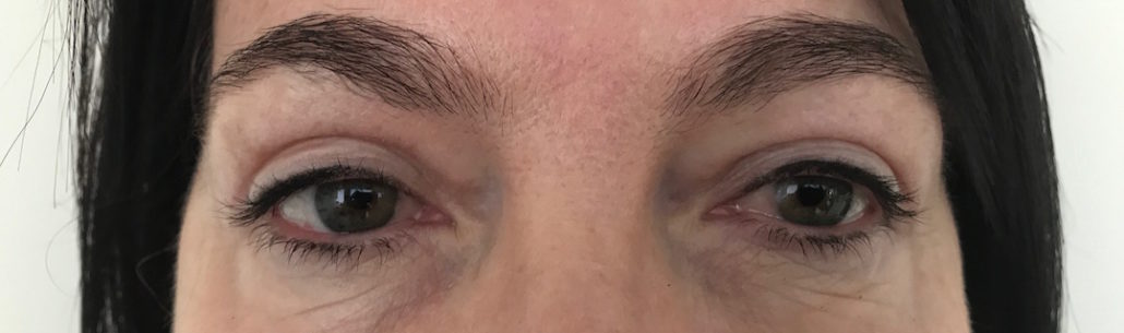 Blepharoplasty (Eyelid) Before & After Gallery 24 Patient3After | Form & Face